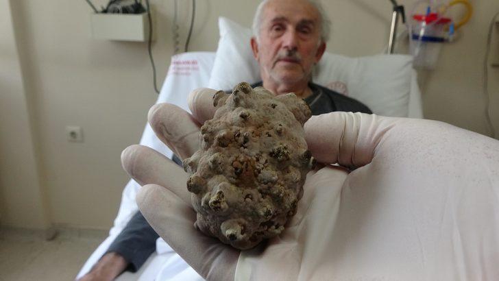 Mesanesinden 130 gramlık taş çıkarıldı; Kendimi hafiflemiş hissediyorum G5