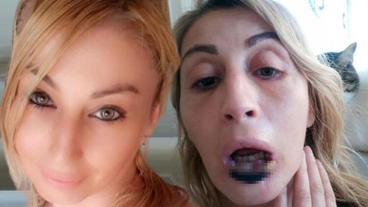 Antalya'da estetik faciası! 'Dudağım çürüdü, düştü' G4