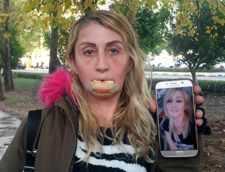 Antalya'da estetik faciası! 'Dudağım çürüdü, düştü' G3