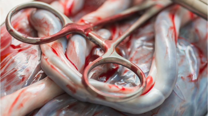 Göbek bağının geç kesilmesi hayat kurtarıyor