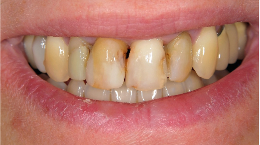 G&uuml;zel g&ouml;r&uuml;n&uuml;m i&ccedil;in yaptırıyoruz ama doktor kontrol&uuml;nde değilse diş beyazlatma jeli kullanmayın 