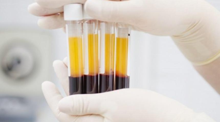 PRP nedir? PRP nasıl uygulanır? PRP nasıl elde edilir?