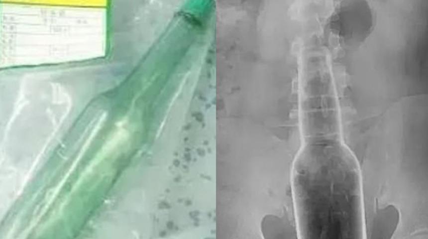 Rektumundan cam şişe çıkarılan adamdan açıklama: Kaşınıyordu!