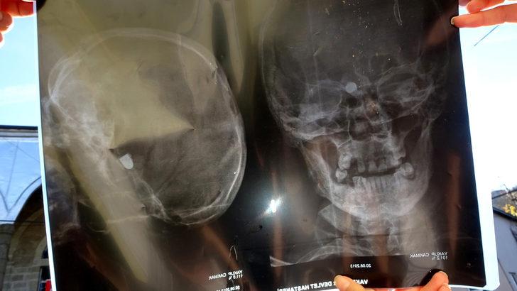 9 yaşındayken başına kurşun isabet etti, 47 yıldır öyle yaşıyor... "Hayatım karardı" G1