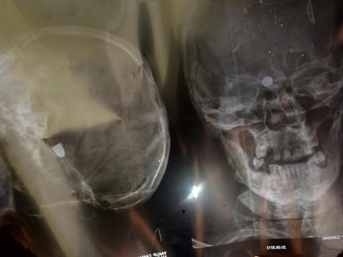 Trabzon'da Yakup &Ccedil;akmak 47 yıldır başında maganda kurşunuyla yaşıyor