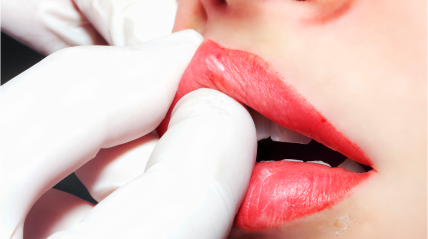 Her kadının dudak yapısı farklı! Dudak dolgusu yaptırırken bunlara dikkat edin