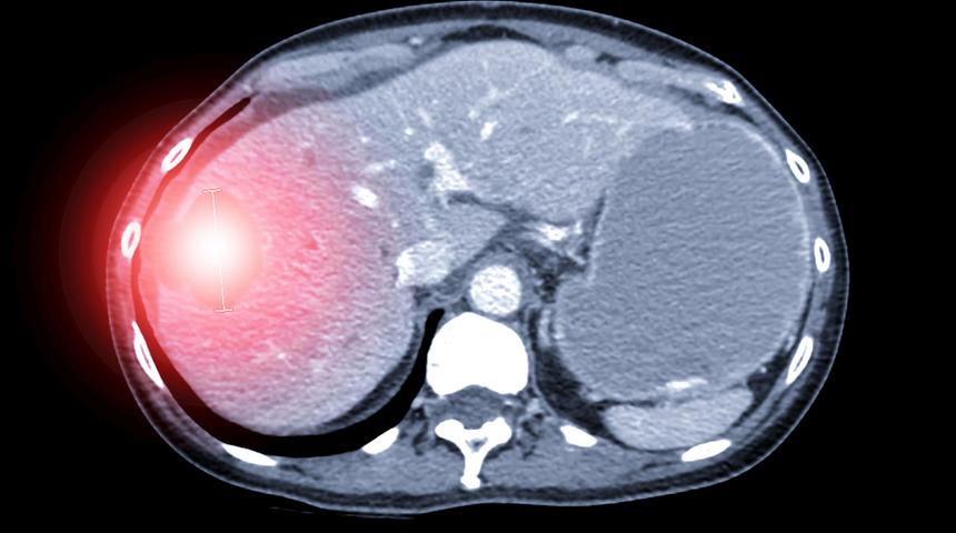 Köpek kisti organ nakline kadar götürebilir