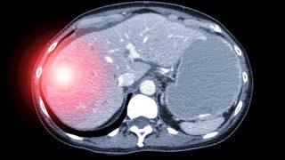 Köpek kisti organ nakline kadar götürebilir