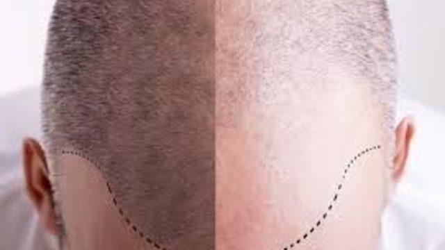 DHI saç ekimi birçok avantaj sağlıyor