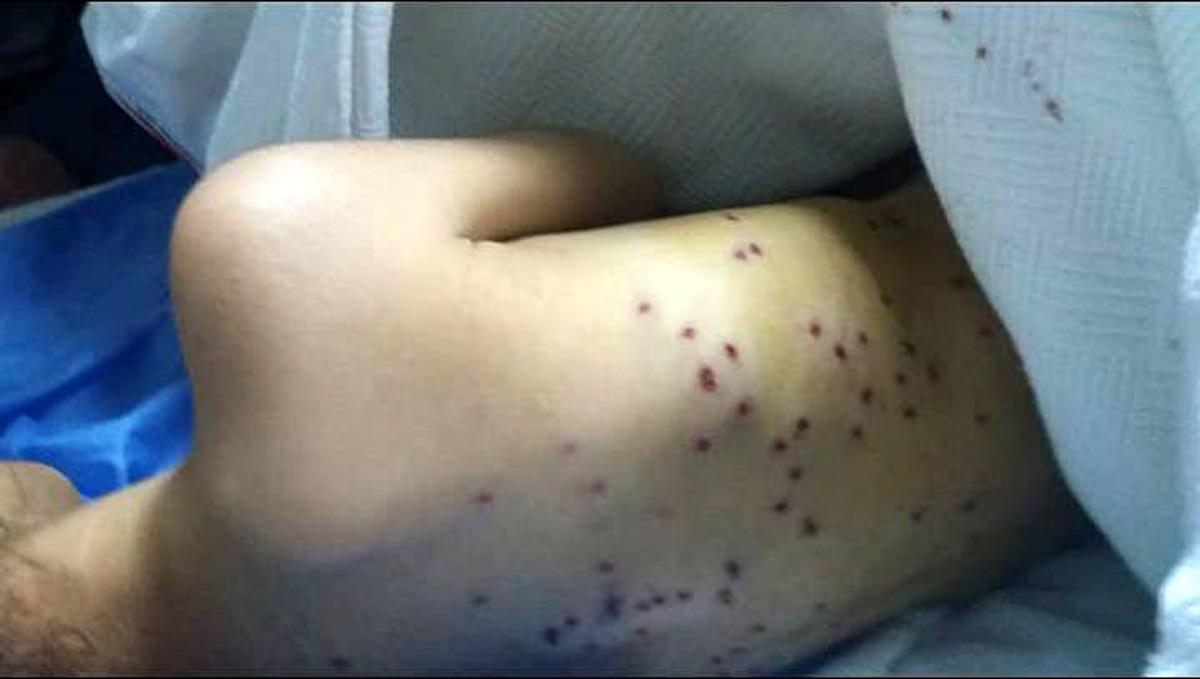 Mersin'de 4 yaşındaki Berra'nın sırtına 100 sa&ccedil;ma isabet etti