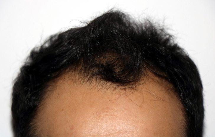 Saç kazanacağım derken, erkekliğinizi kaybedebilirsiniz G2