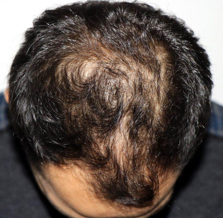 Saç kazanacağım derken, erkekliğinizi kaybedebilirsiniz G3