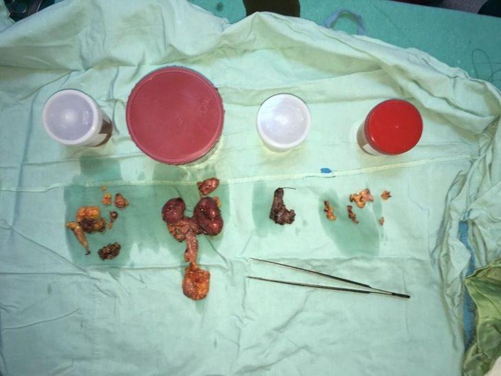 7 santimlik kanserli lenf bezleri 10 saatte temizlendi G5