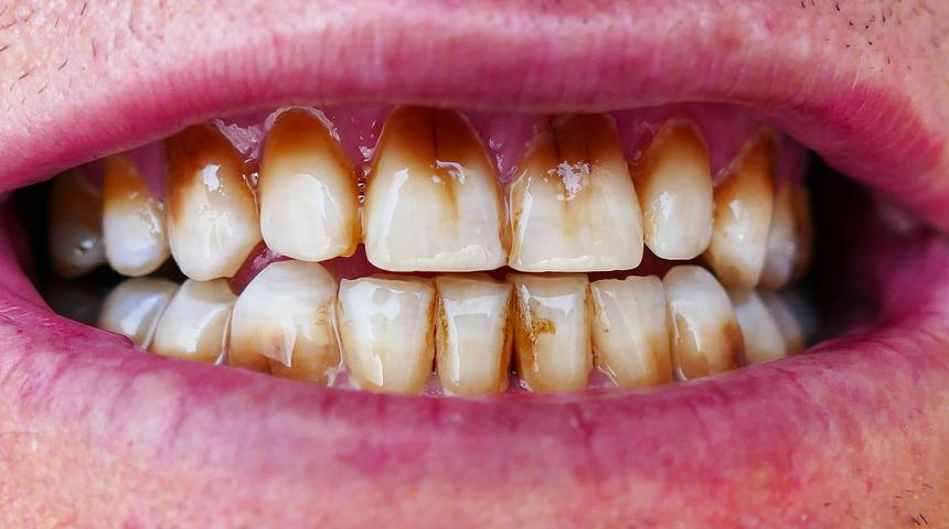 Karbonatla diş beyazlatma zararlı mı? Evde diş beyazlatma yöntemlerine dikkat