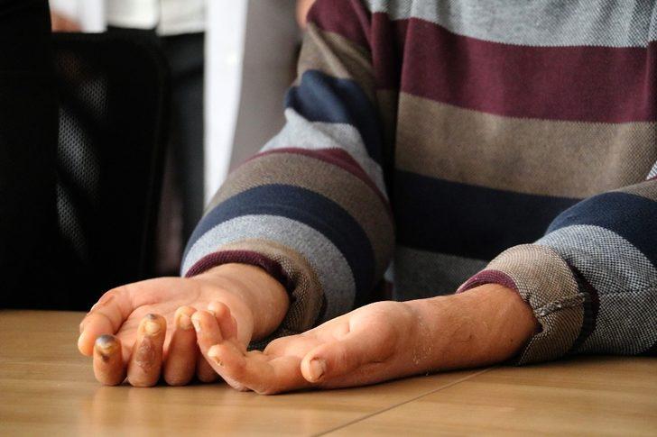 Çift kol nakli yapılan Yusuf: "Elimi kolumu sallayarak gezeceğim" G2