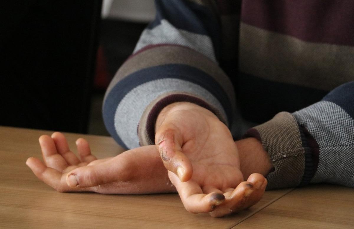 &Ccedil;ift kol nakli yapılan Yusuf kameraların karşısına ge&ccedil;ti: Elimi kolumu sallayarak gezeceğim