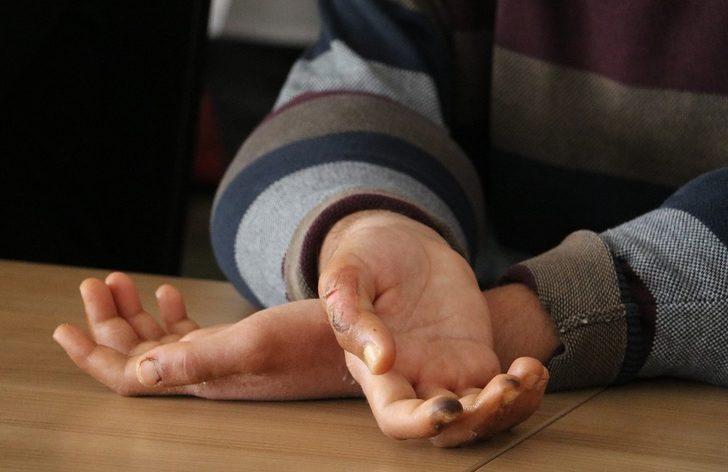 Çift kol nakli yapılan Yusuf: "Elimi kolumu sallayarak gezeceğim" G3