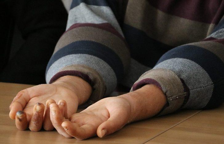 Çift kol nakli yapılan Yusuf: "Elimi kolumu sallayarak gezeceğim" G5