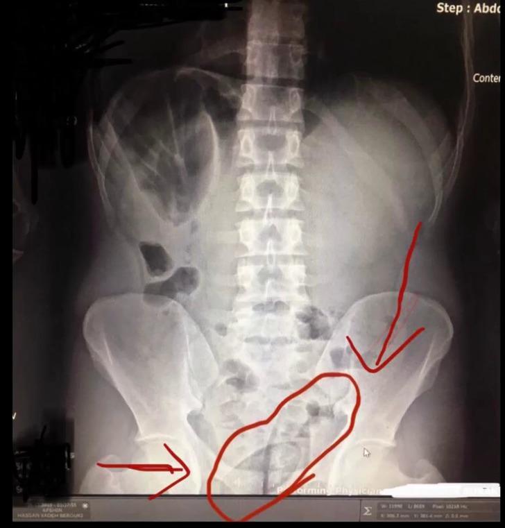 Bağırsaklarından çıkanlar doktorları bile şaşırttı! G1