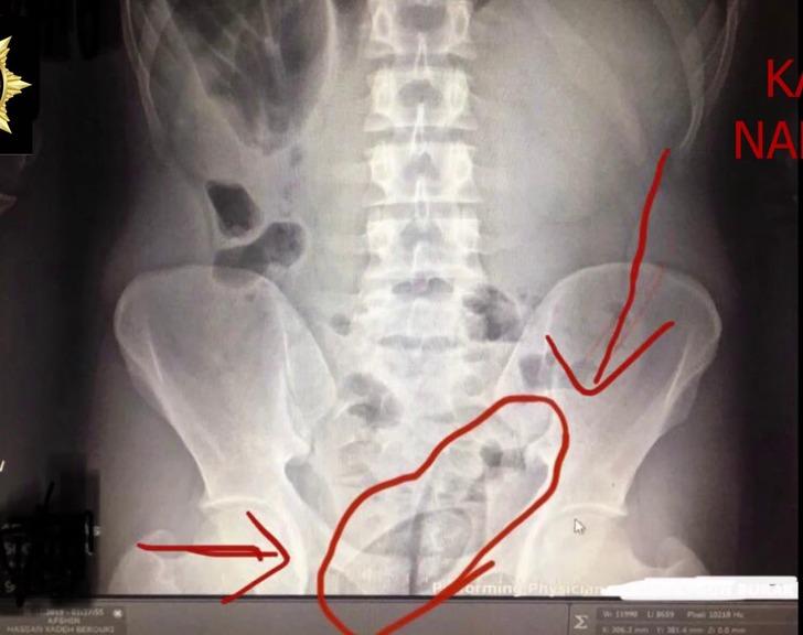 Bağırsaklarından çıkanlar doktorları bile şaşırttı! G2