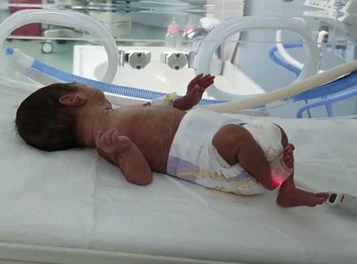 540 gram doğan Sümeyye bebek, kör olmaktan kurtuldu Sağlık Haberleri