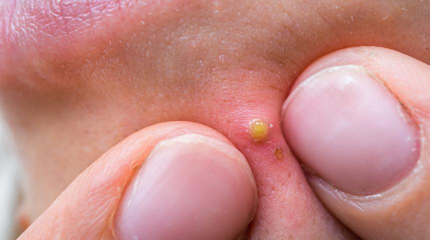 Yüzdeki sivilce izleri, lekeleri nasıl geçer?