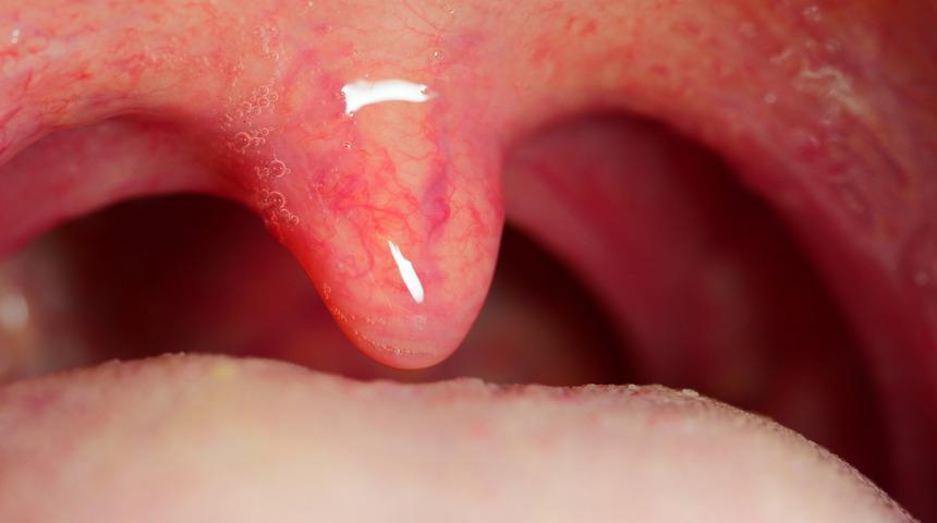 Boğaz ağrısına ne iyi gelir? Boğaz ağrısına iyi gelen doğal tedavi yöntemleri ile şikayet 1 saate son buluyor