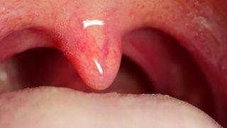 Boğaz ağrısına ne iyi gelir? Boğaz ağrısına iyi gelen doğal tedavi yöntemleri ile şikayet 1 saate son buluyor