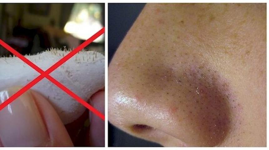  Siyah noktalar ve aknelerden kurtulmak i&ccedil;in zerde&ccedil;al maskesi tarifi