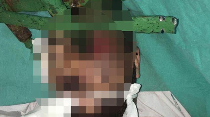 Antalya’da korkunç olay! Yüzüne demir çubuk saplandı