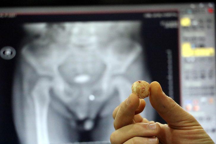 Zonguldak'ta 3 yaşındaki çocuğun mesanesinden çıkan taş şaşırttı G1