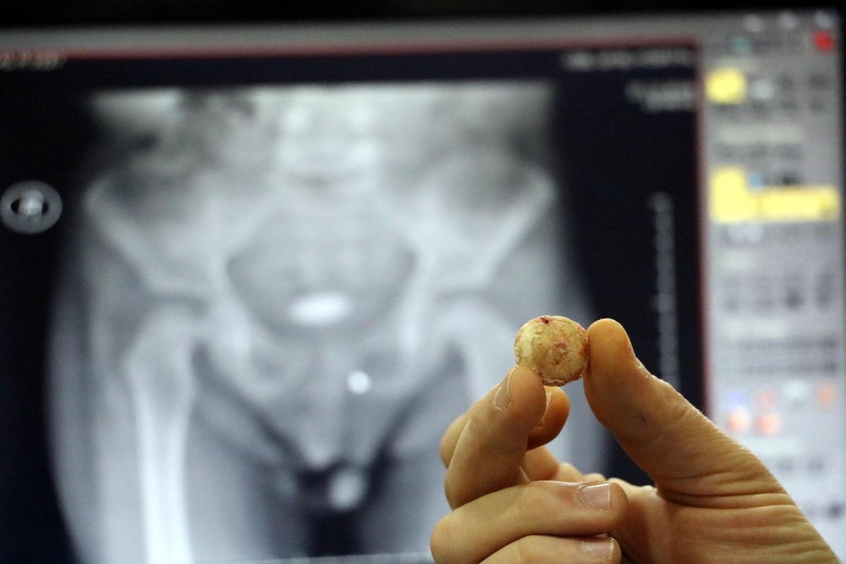 Zonguldak'ta 3 yaşındaki &ccedil;ocuğun mesanesinden &ccedil;ıkan taş şaşırttı