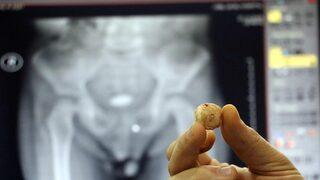 Zonguldak'ta 3 yaşındaki çocuğun mesanesinden çıkan taş şaşırttı