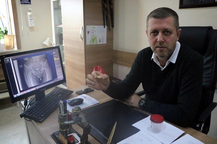 Zonguldak'ta 3 yaşındaki çocuğun mesanesinden çıkan taş şaşırttı G2