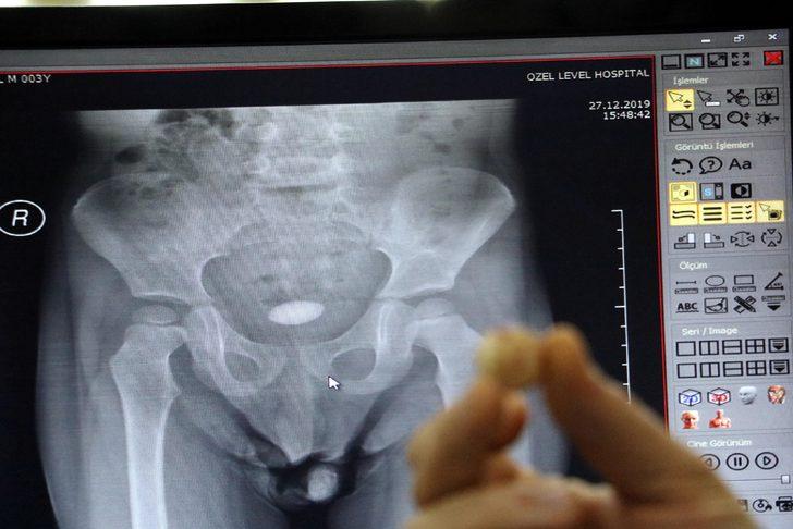 Zonguldak'ta 3 yaşındaki çocuğun mesanesinden çıkan taş şaşırttı G3