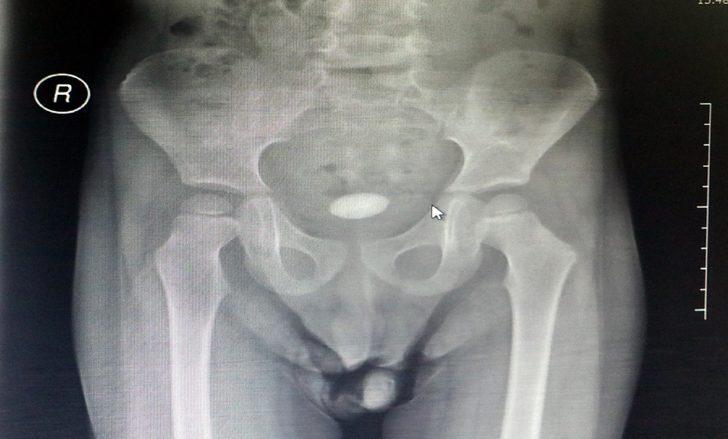 Zonguldak'ta 3 yaşındaki çocuğun mesanesinden çıkan taş şaşırttı G4