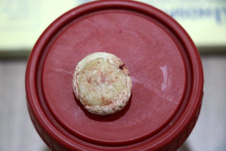 Zonguldak'ta 3 yaşındaki çocuğun mesanesinden çıkan taş şaşırttı G5