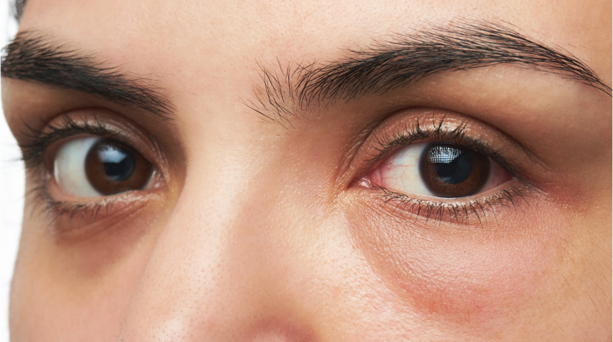 Göz altı torbası neden olur? Göz altı torbalarını yok etmek mümkün mü?