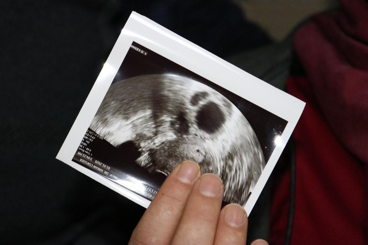 İnternetten ulaştığı doktora gitti, 11 yıllık &ccedil;ocuk hasreti akupunktur tedavisiyle son buldu