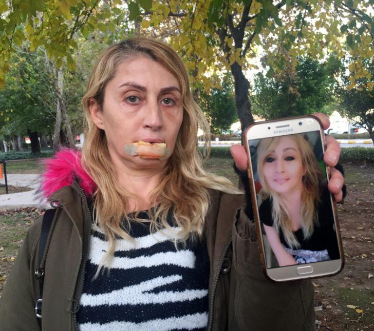 Antalya'da dudağı çürüyen kadına müjdeli haber!  G3