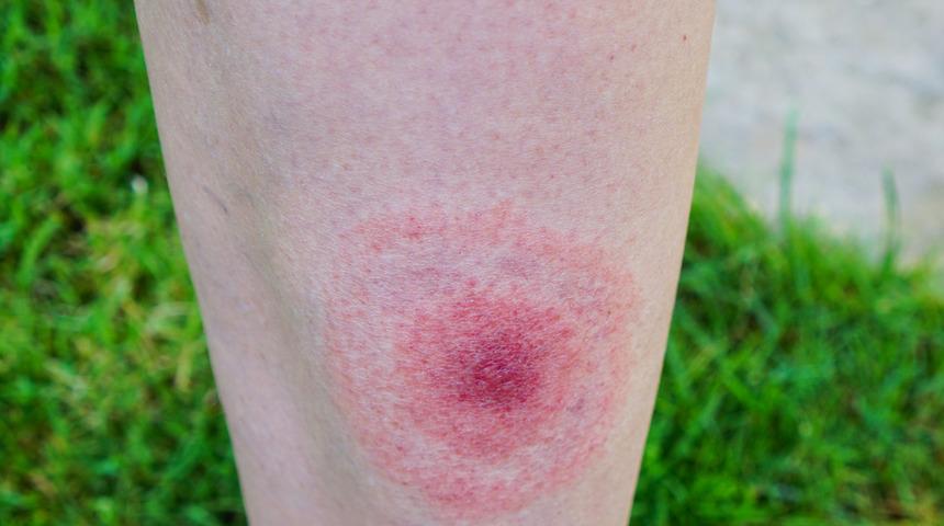 Lyme hastalığı nedir? Lyme tedavisinde hangi ilaçlar kullanılır?