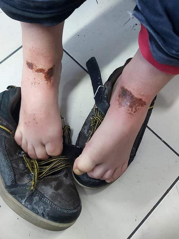 Kar topu oynayan 9 çocuğun vücudunda yanıklar oluştu! Vali Mustafa Tutulmaz'dan açıklama G1