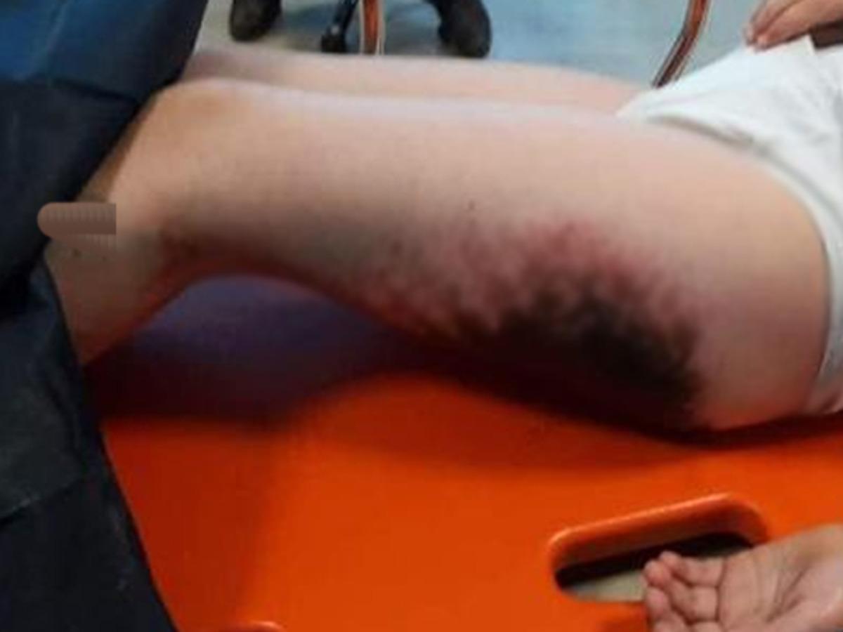 Kar topu oynayan 9 &ccedil;ocuğun v&uuml;cudunda yanıklar oluştu! Vali Mustafa Tutulmaz'dan a&ccedil;ıklama