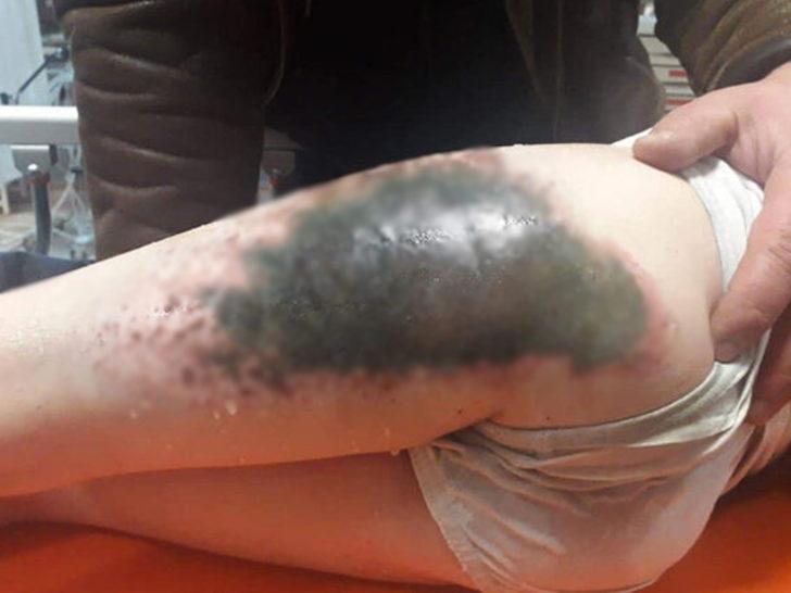 Kar topu oynayan 9 çocuğun vücudunda yanıklar oluştu! Vali Mustafa Tutulmaz'dan açıklama G3