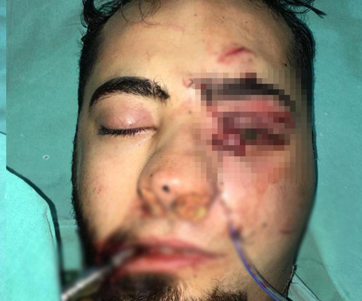 Yüzüne demir saplanmıştı! Emre'den iyi haber geldi G1