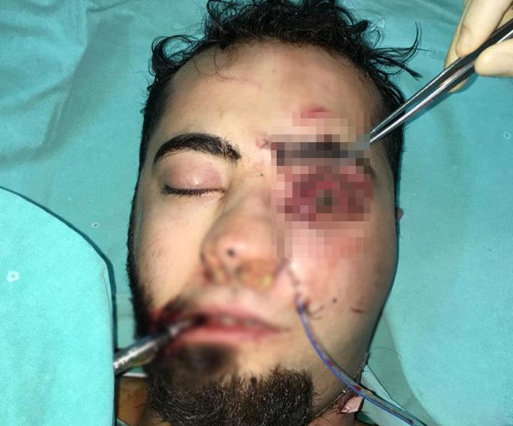 Yüzüne demir saplanmıştı! Emre'den iyi haber geldi G3