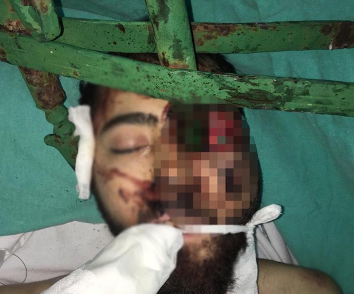 Yüzüne demir saplanmıştı! Emre'den iyi haber geldi G2