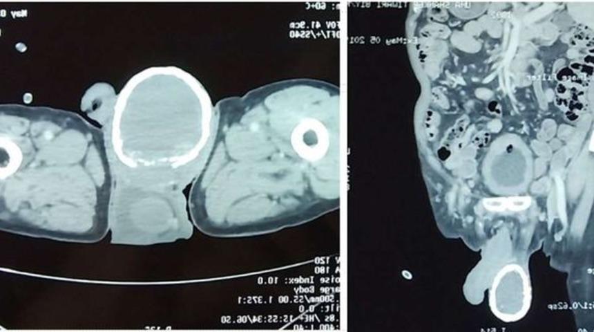 İnanılmaz! Testisi yumurta kabuğuyla kaplandı