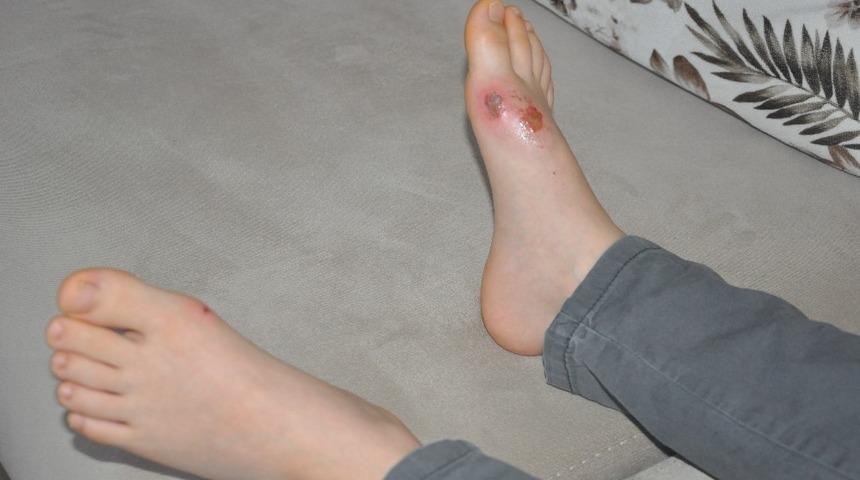 Kartopu oynayan çocukların vücudundaki yanıklar gizemini koruyor 