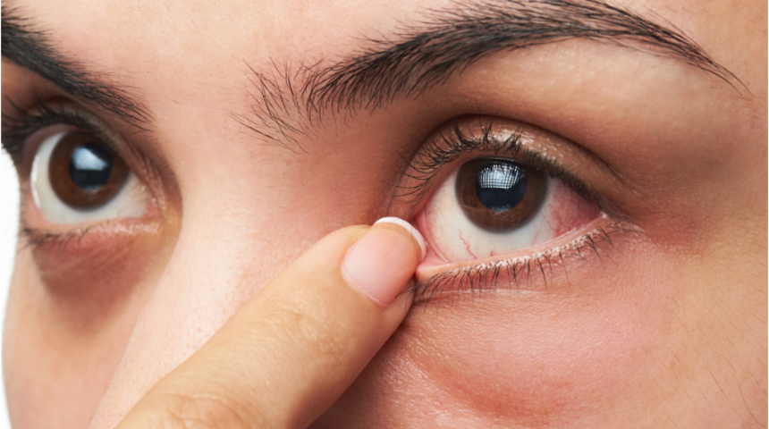 Astigmat nedir, belirtileri nelerdir?